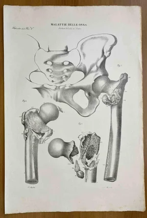 Ottavio Muzzi, Bone Diseases, Lithograph, 1843