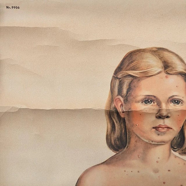 Vintage Training Poster with Childhood Illnesses, 1930-1940, in Good conditions. Designed 1920 to 1949 This piece has an...