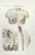 Breast Diseases is a lithograph hand colored by Ottavio Muzzi for the edition of Antoine Chazal,Human Anatomy, Printers...