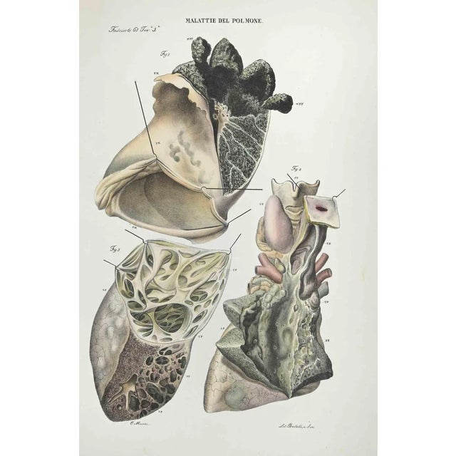 Ottavio Muzzi, Diseases of the Brain, Lithograph, 1843 For Sale