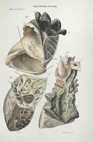 Ottavio Muzzi, Diseases of the Brain, Lithograph, 1843