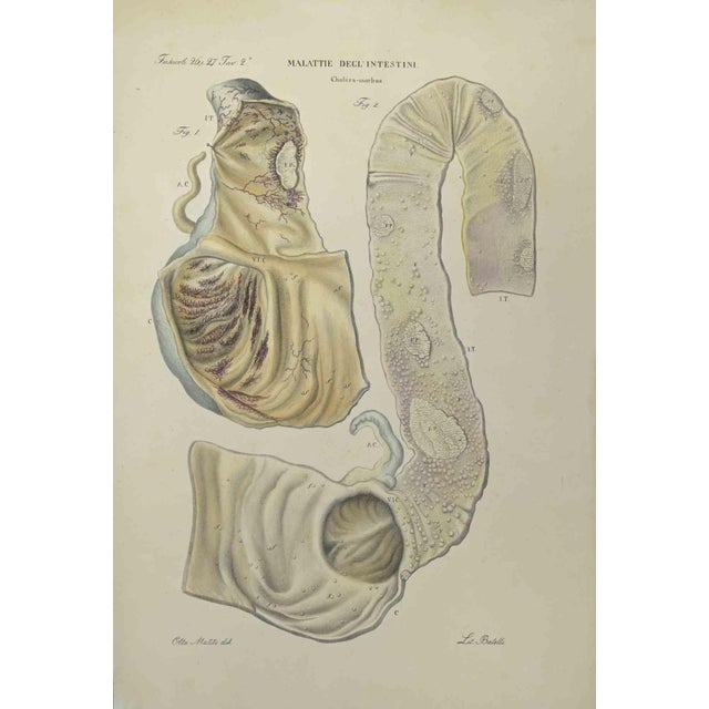 Bowel Diseases is a lithograph hand colored by Ottavio Muzzi for the edition of Antoine Chazal, Human Anatomy, Printers...