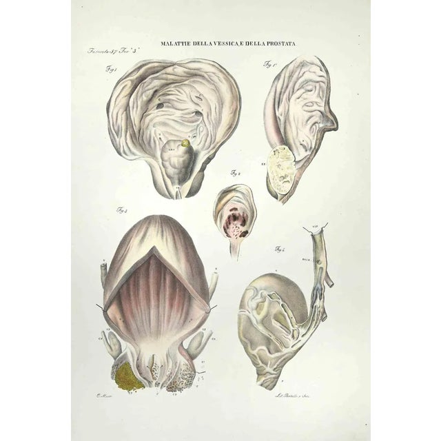 Bladder and Prostate Diseases is a lithograph hand colored by Ottavio Muzzi for the edition of Antoine Chazal,Human...