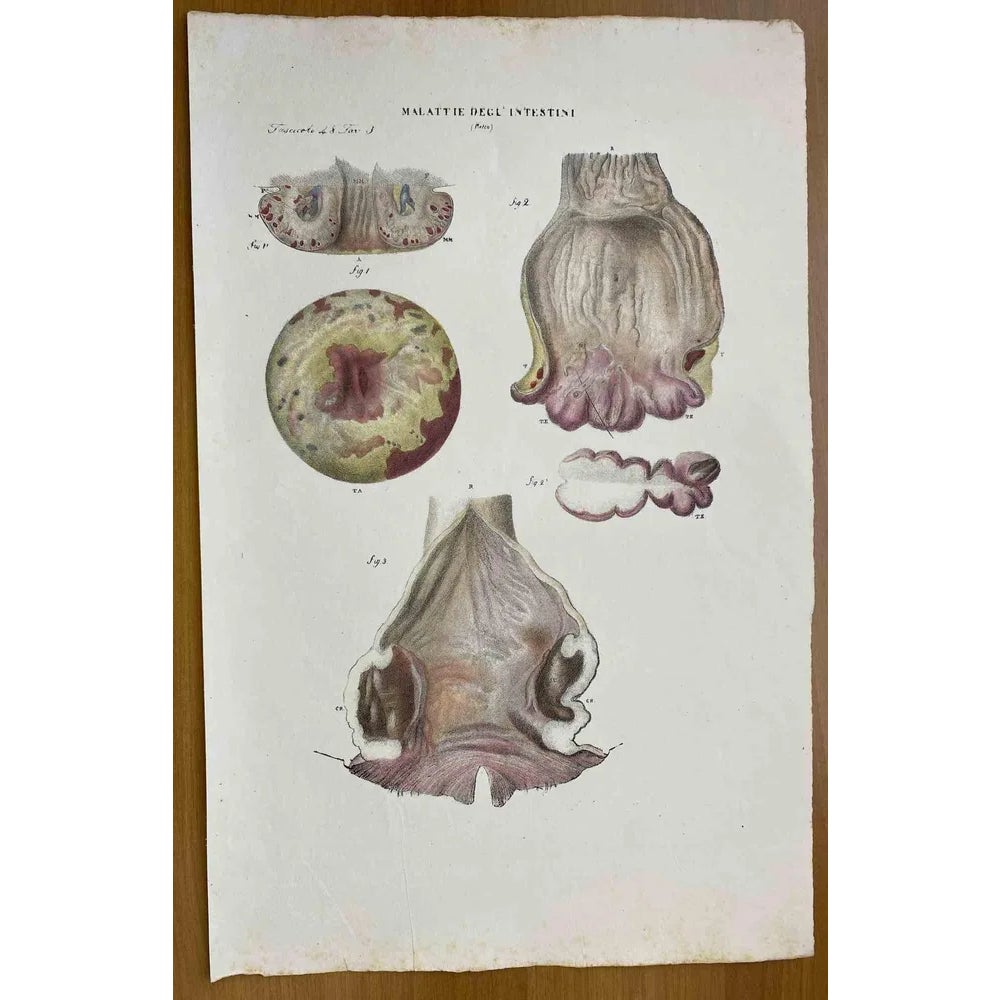 Ottavio Muzzi, Intestine Diseases, Lithograph, 1843 | Chairish