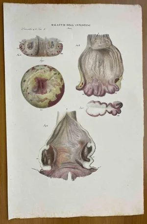 Ottavio Muzzi, Intestine Diseases, Lithograph, 1843