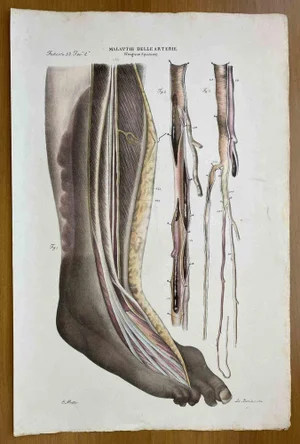Ottavio Muzzi, Diseases of the Arteries, Lithograph, 1843