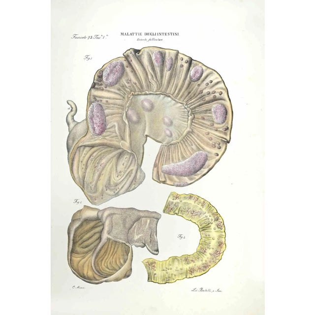 Diseases of the Intestines is a lithograph hand colored by Ottavio Muzzi for the edition of Antoine Chazal,Human Anatomy,...