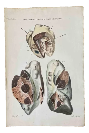 Ottavio Muzzi, Apoplexy of the Heart and Lungs, Lithograph, 1843