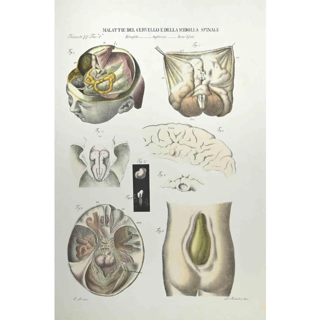 Diseases of the Brain and Spinal Cord is a lithograph hand colored by Ottavio Muzzi for the edition of Antoine...