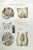 Diseases of the Brain and Spinal Cord is a lithograph hand colored by Ottavio Muzzi for the edition of Antoine...