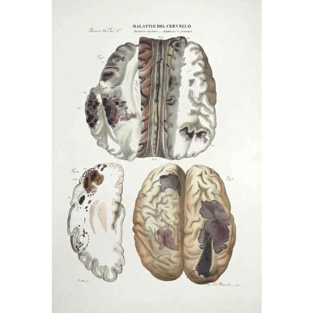 Brain Diseases is a lithograph hand colored by Ottavio Muzzi for the edition of Antoine Chazal,Human Anatomy, Printers...