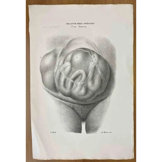 Conformation Defects is a lithograph hand colored by Ottavio Muzzi for the edition of Antoine Chazal, Human Anatomy,...