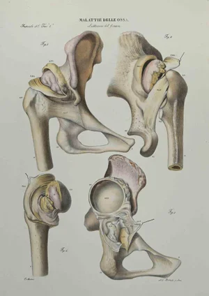 Ottavio Muzzi, Bone Disease, Lithograph, 1843