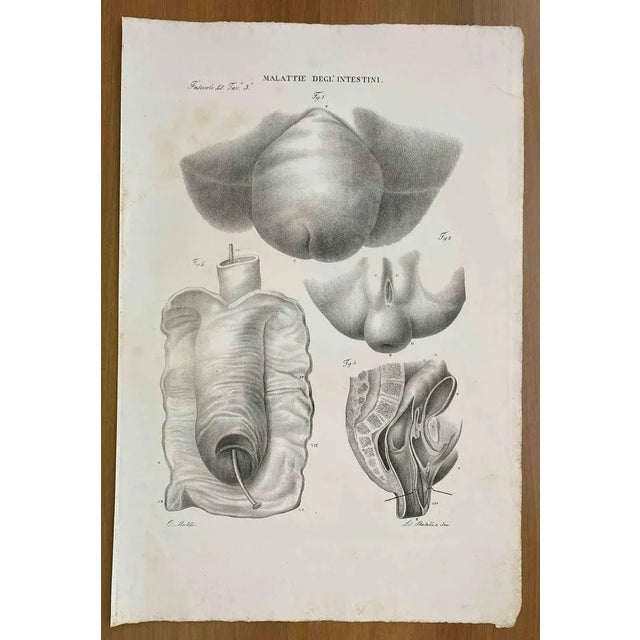 Intestinal Diseases is a lithograph hand colored by Ottavio Muzzi for the edition of Antoine Chazal, Human Anatomy,...