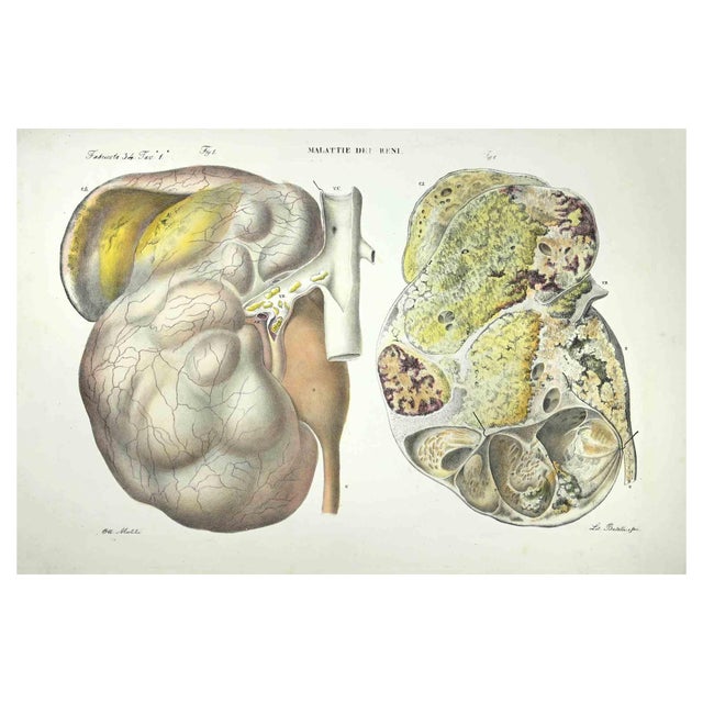 Ottavio Muzzi, Kidney Diseases, Lithograph, 1843 For Sale