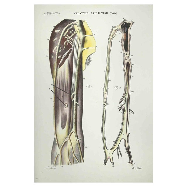 Ottavio Muzzi, Vein Diseases, Lithograph, 1843 For Sale