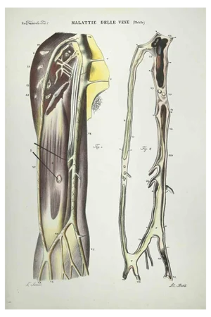 Ottavio Muzzi, Vein Diseases, Lithograph, 1843