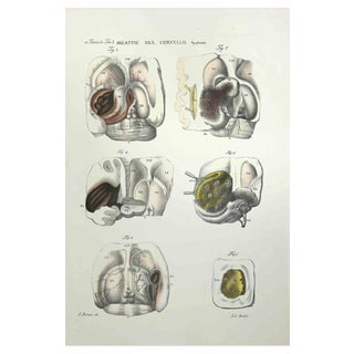 Ottavio Muzzi, Brain Diseases, Lithograph, 1843 For Sale