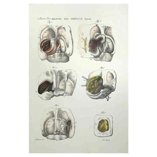 Ottavio Muzzi, Brain Diseases, Lithograph, 1843 For Sale