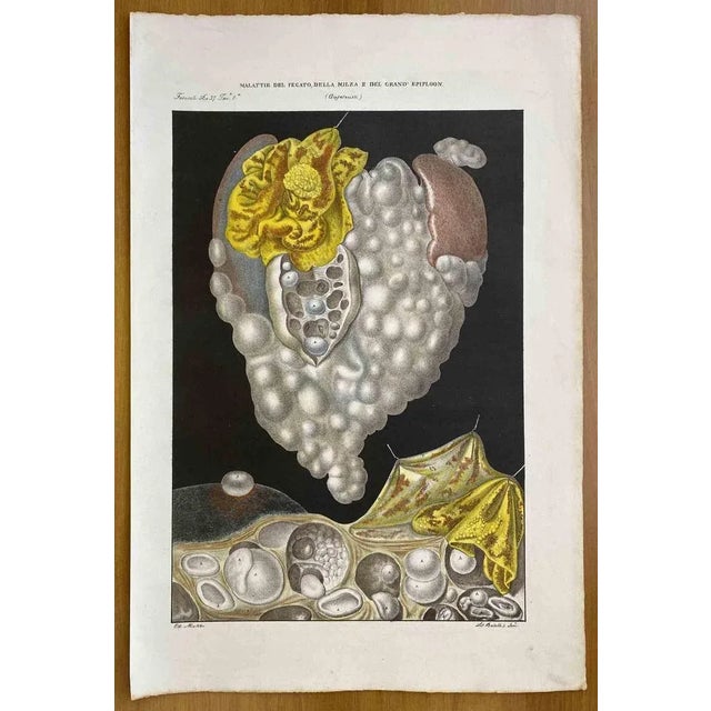 Diseases of the Liver, Spleen and Epiploon is a lithograph hand colored by Ottavio Muzzi for the edition of Antoine...