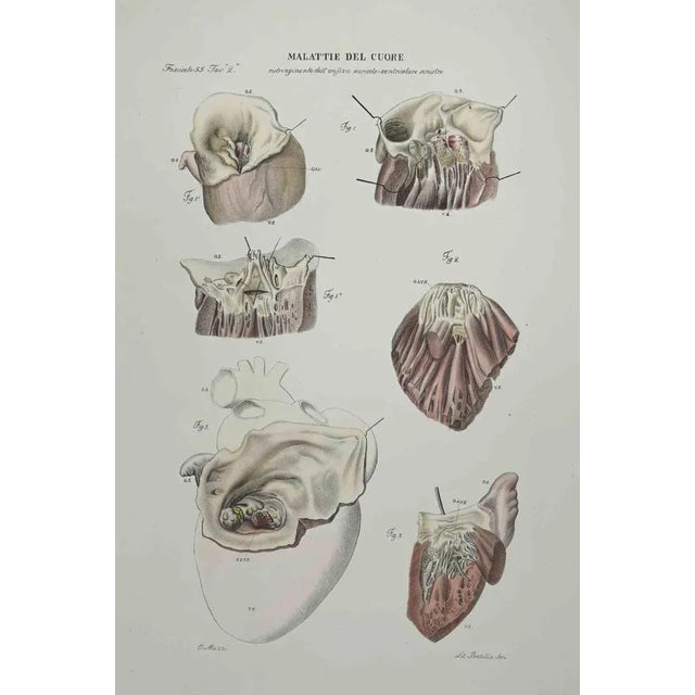 Heart Disease is a lithograph hand colored by Ottavio Muzzi for the edition of Antoine Chazal, Human Anatomy, Printers...