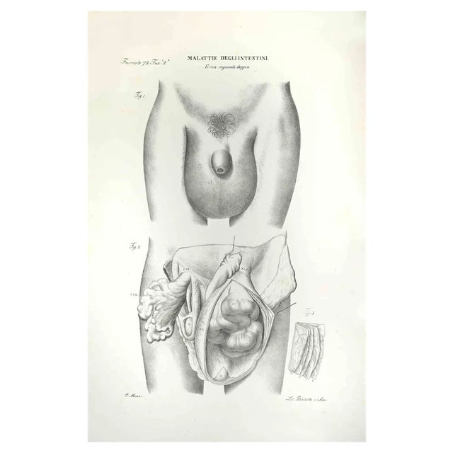 Ottavio Muzzi, Diseases of the Intestines, Lithograph, 1843 For Sale