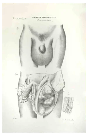 Ottavio Muzzi, Diseases of the Intestines, Lithograph, 1843