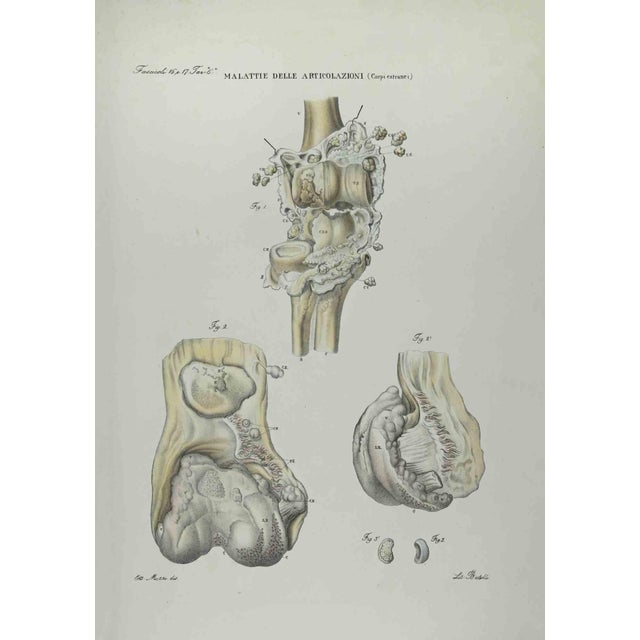 Joint Diseases is a lithograph hand colored by Ottavio Muzzi for the edition of Antoine Chazal, Human Anatomy, Printers...