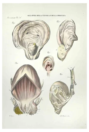 Ottavio Muzzi, Bladder and Prostate Diseases, Lithograph, 1843