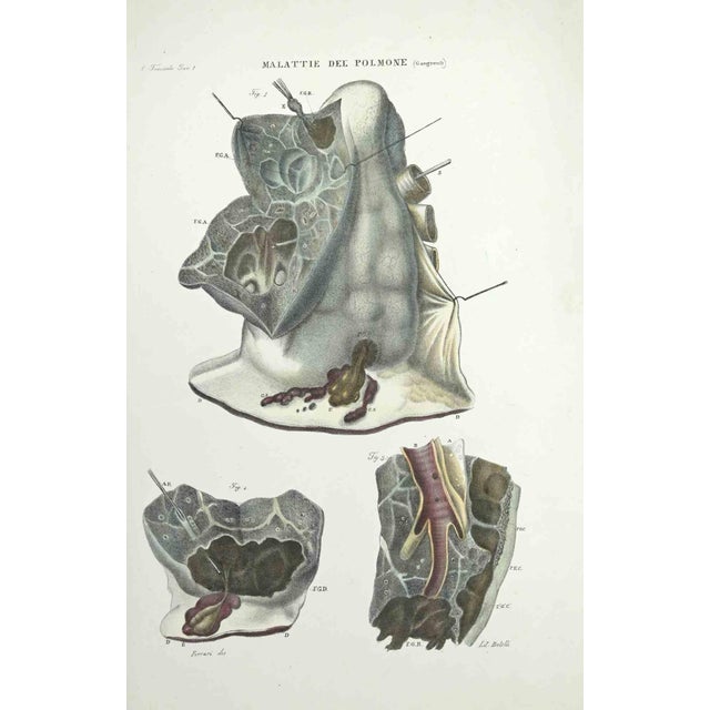 Lung Diseases is a lithograph hand colored by Ottavio Muzzi for the edition of Antoine Chazal, Human Anatomy, Printers...