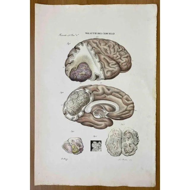 Brain Disease is a lithograph hand colored by Ottavio Muzzi for the edition of Antoine Chazal, Human Anatomy, Printers...
