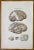 Brain Disease is a lithograph hand colored by Ottavio Muzzi for the edition of Antoine Chazal, Human Anatomy, Printers...