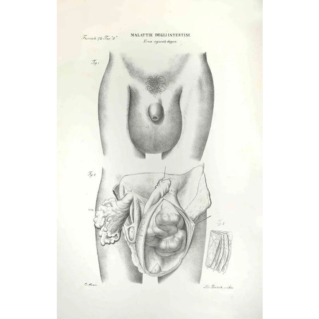 Diseases of the Intestines is a lithograph hand colored by Ottavio Muzzi for the edition of Antoine Chazal,Human Anatomy,...
