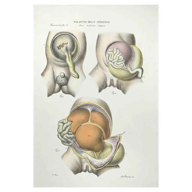 Ottavio Muzzi, Diseases of the Intestines, Lithograph, 1843 For Sale