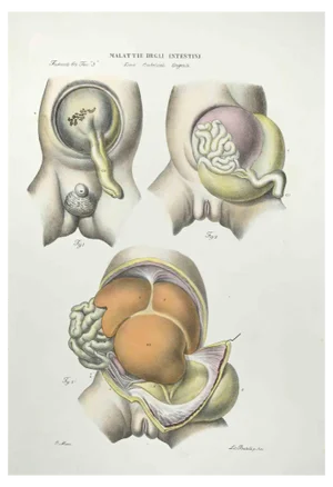 Ottavio Muzzi, Diseases of the Intestines, Lithograph, 1843
