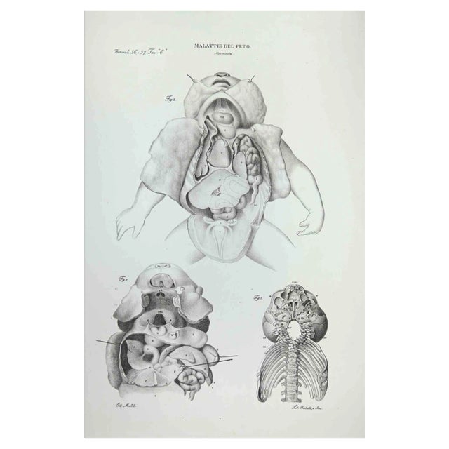 Ottavio Muzzi, Fetus Diseases, Lithograph, 1843 For Sale