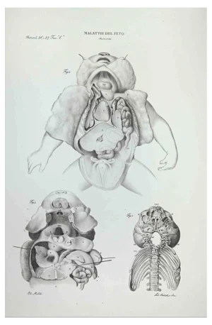 Ottavio Muzzi, Fetus Diseases, Lithograph, 1843