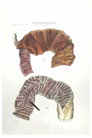 Ottavio Muzzi, Diseases of the Intestines, Lithograph, 1843