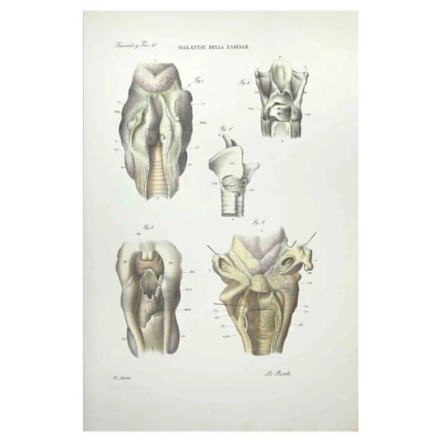 Ottavio Muzzi, Diseases of the Laringe, Lithograph, 1843 For Sale