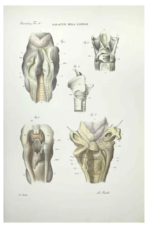 Ottavio Muzzi, Diseases of the Laringe, Lithograph, 1843