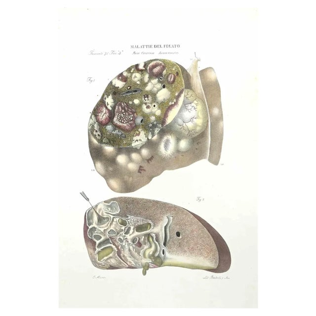 Ottavio Muzzi, Liver Diseases, Lithograph, 1843 For Sale