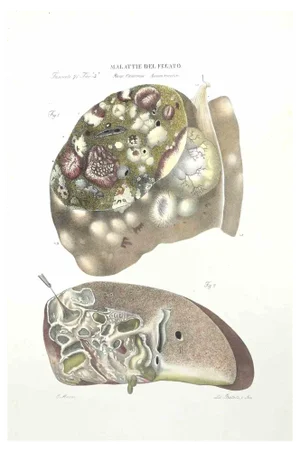 Ottavio Muzzi, Liver Diseases, Lithograph, 1843