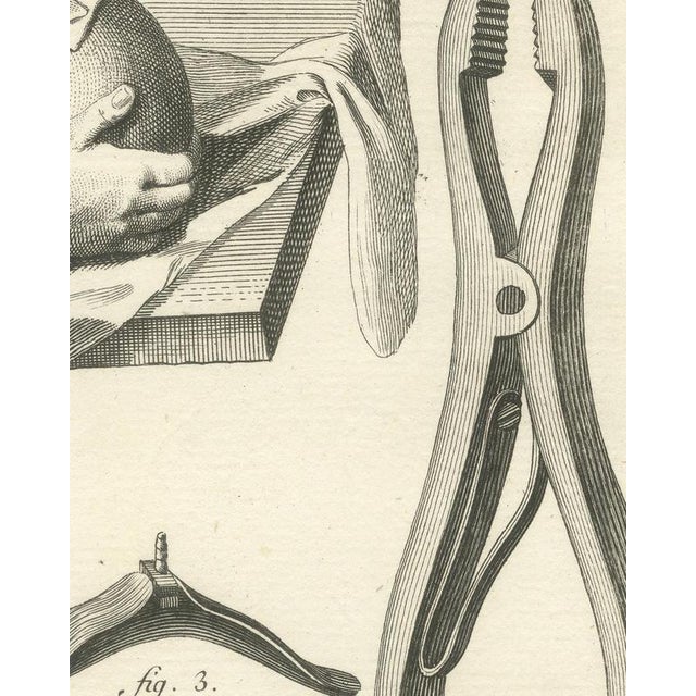 Antonio Baratti, Trepanning the Skull and Cautery Irons, Diderot Chirurgie Plate Xvii, 1772, Engraving For Sale - Image 4 of 8
