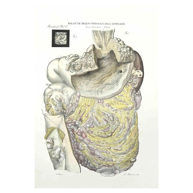 Ottavio Muzzi, Disease of the Stomach of Epiploon, Lithograph, 1843 For Sale