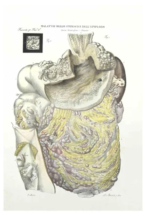 Ottavio Muzzi, Disease of the Stomach of Epiploon, Lithograph, 1843