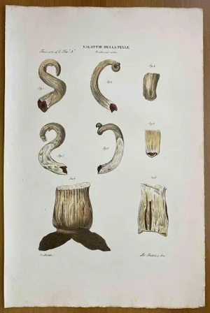 Ottavio Muzzi, Diseases of Skin, Lithograph, 1843