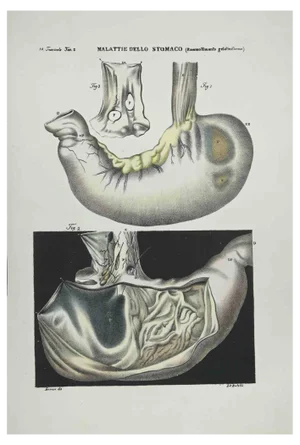 Ottavio Muzzi, Stomach Diseases, Lithograph, 1843