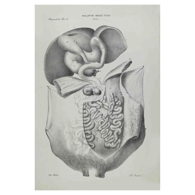 Ottavio Muzzi, Veins Diseases, Lithograph, 1843 For Sale