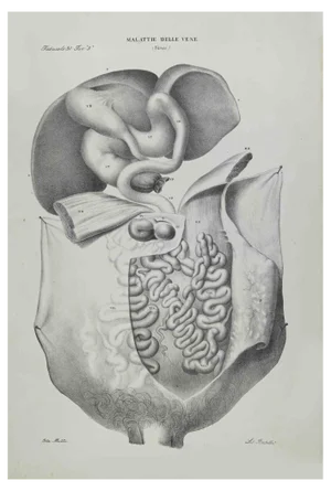 Ottavio Muzzi, Veins Diseases, Lithograph, 1843