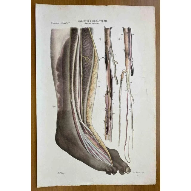 Diseases of the Arteries is a lithograph hand colored by Ottavio Muzzi for the edition of Antoine Chazal, Human Anatomy,...